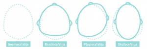 plagiocefalijos-tipai2